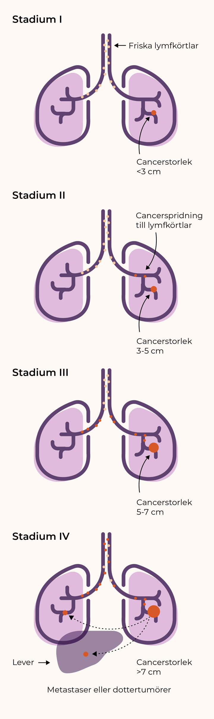 Grafik som visar lungcancer stadium